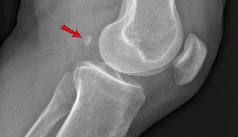 Knie tut weh? Vielleicht