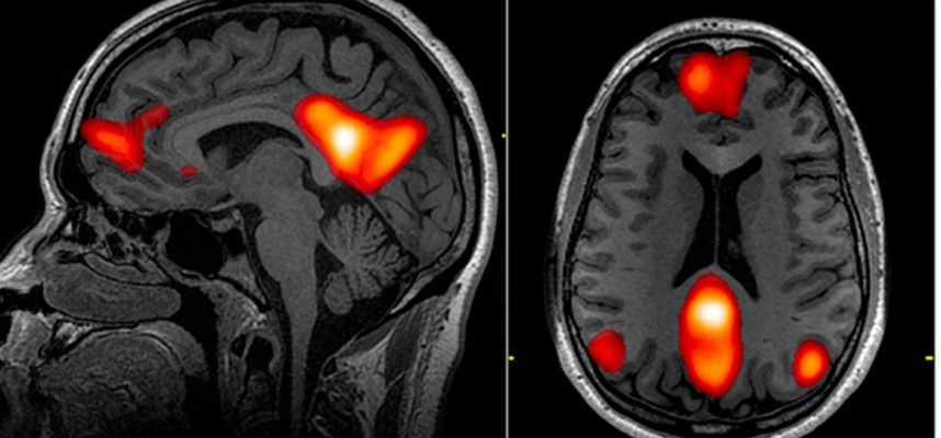 Gehirnscans zeigen das gesamte Spektrum der COVID-19-Anomalien, die Wissenschaftler nicht erklären können 