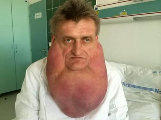 Ärzte haben einem Mann einen riesigen Tumor aus dem Gesicht entfernt